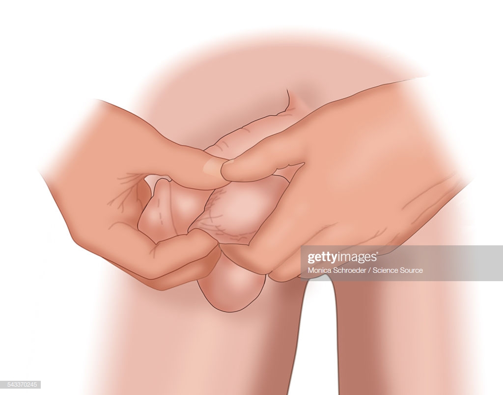 Illustration of a testicular self-examination (TSE). It is recommended that men ages 15-40 perform regular self-examinations to detect lumps or abnormalities of the testicles. Many testicular cancers are discovered by self-examination as a painless lump or an enlarged testicle.